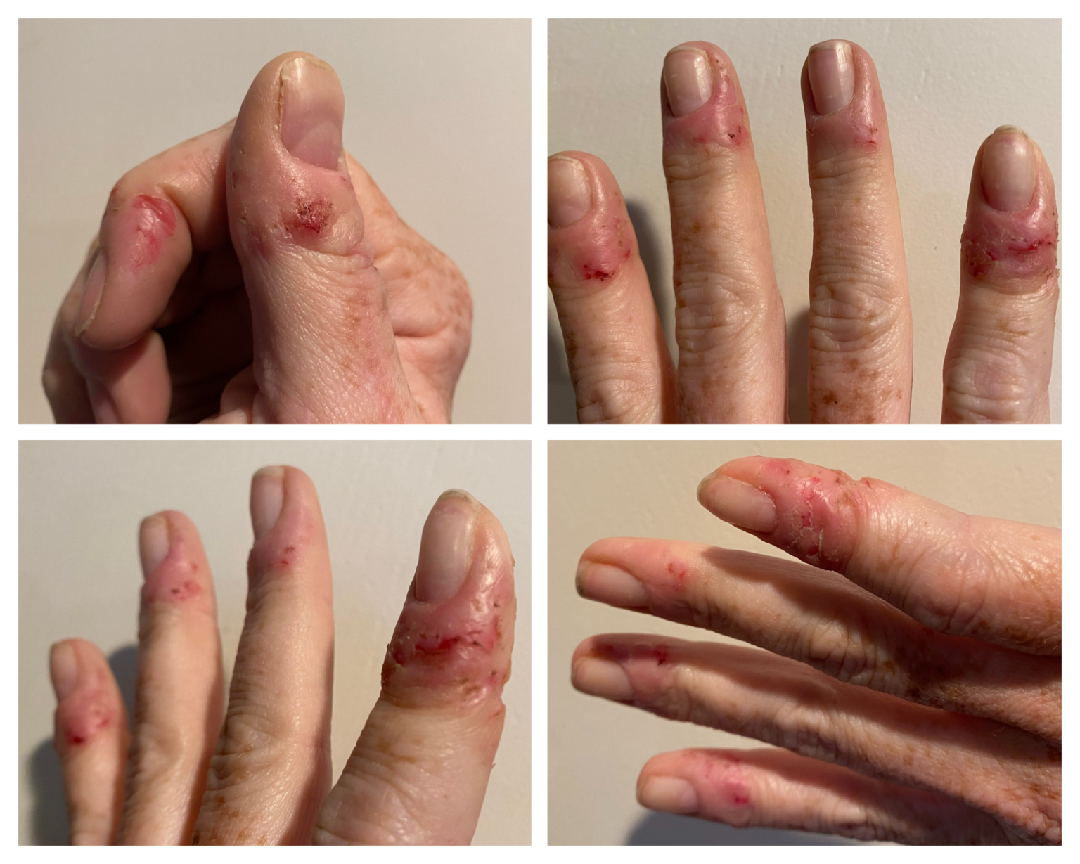 what-is-dermatophagia-and-why-do-people-do-this-to-themselves